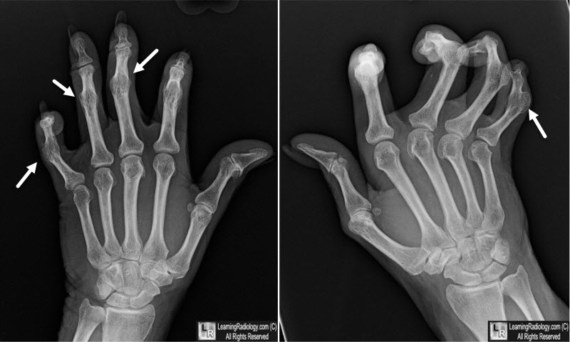 Psoriatic Arthritis